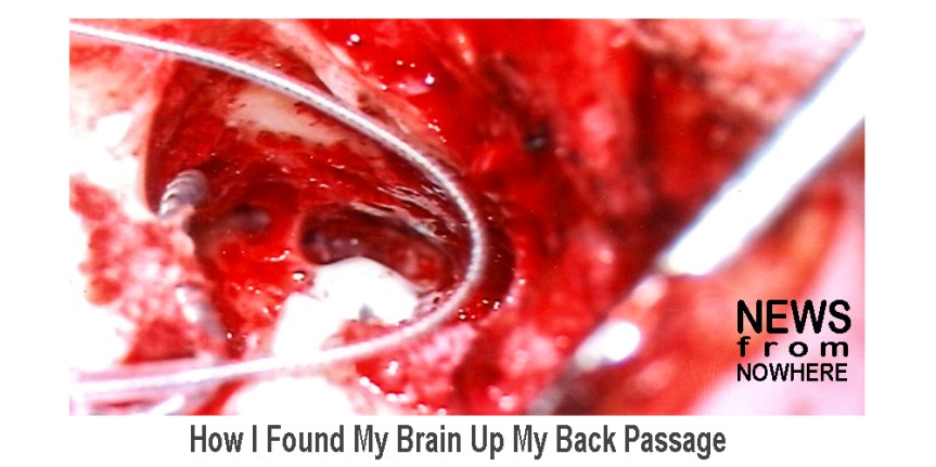 How I Found My Brain Up My Back&nbsp;Passage